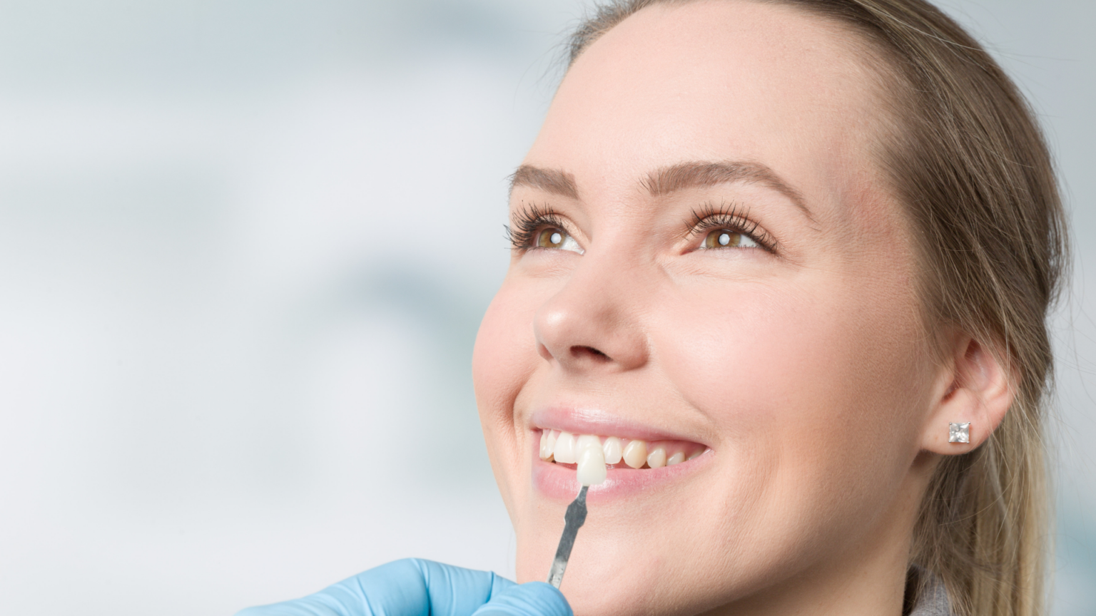3 Incredible Benefits of Dental Veneers